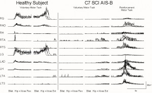 surface EMG waveforms - healthy left, SCI right - only response to reinforcement maneuver